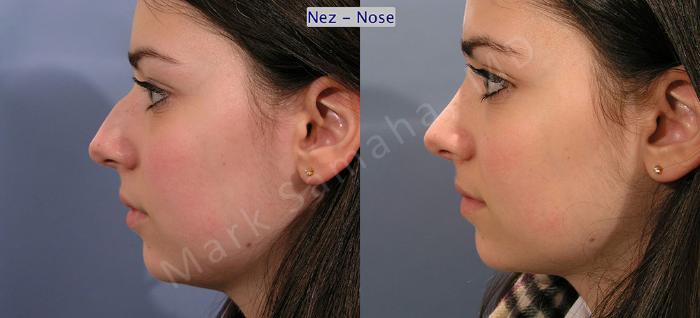 Before & After Rhinoplastie / Rhinoplasty Case 52 View #1 View in Mount Royal, QC