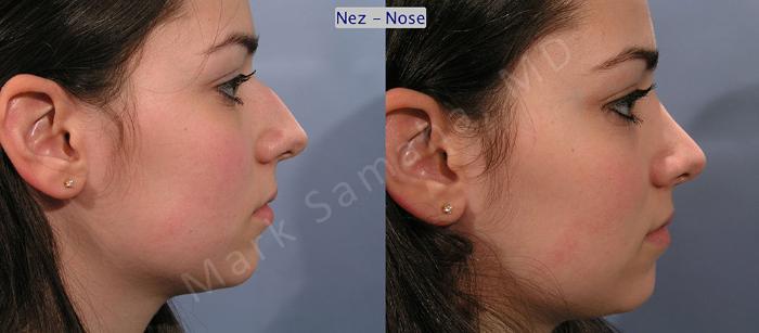 Before & After Rhinoplastie / Rhinoplasty Case 52 View #2 View in Mount Royal, QC