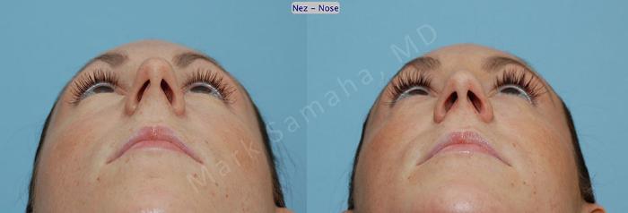 Before & After Rhinoplastie / Rhinoplasty Case 53 View #1 View in Montreal, QC
