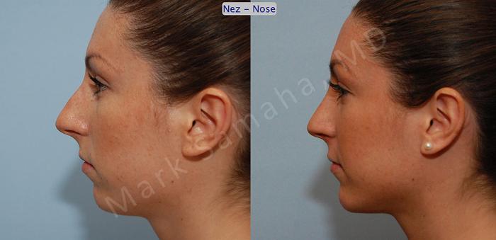 Before & After Rhinoplastie / Rhinoplasty Case 53 View #2 View in Montreal, QC
