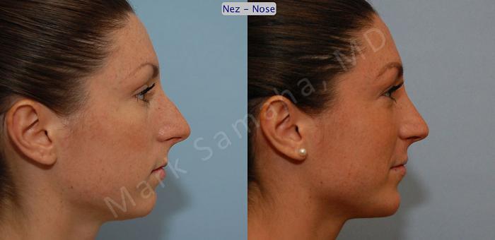 Before & After Rhinoplastie / Rhinoplasty Case 53 View #3 View in Montreal, QC