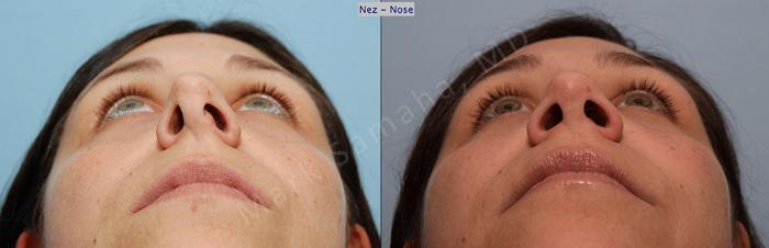 Before & After Rhinoplastie / Rhinoplasty Case 54 View #1 View in Montreal, QC