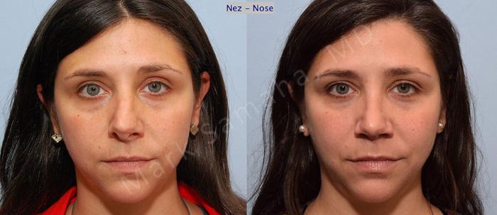 Before & After Rhinoplastie / Rhinoplasty Case 54 View #2 View in Montreal, QC