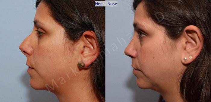 Before & After Rhinoplastie / Rhinoplasty Case 54 View #3 View in Montreal, QC