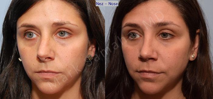 Before & After Rhinoplastie / Rhinoplasty Case 54 View #4 View in Montreal, QC