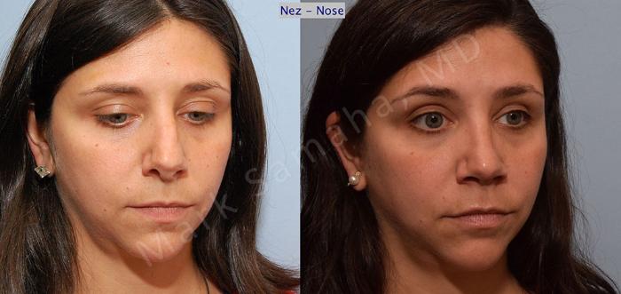 Before & After Rhinoplastie / Rhinoplasty Case 54 View #5 View in Montreal, QC