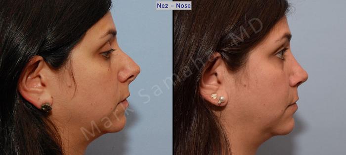 Before & After Rhinoplastie / Rhinoplasty Case 54 View #6 View in Montreal, QC