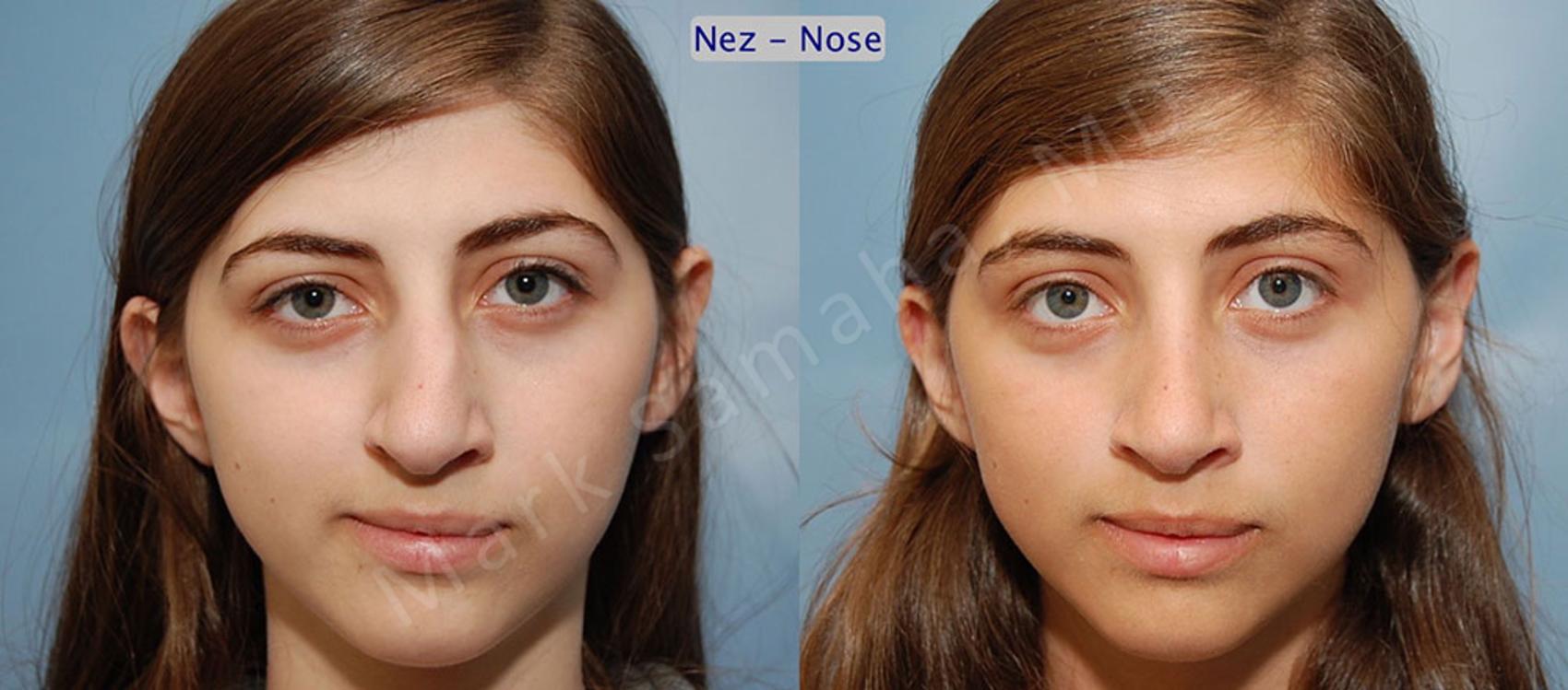 Before & After Rhinoplastie / Rhinoplasty Case 55 View #1 View in Montreal, QC