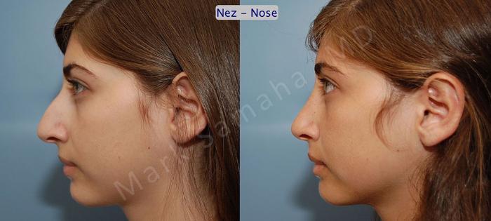 Before & After Rhinoplastie / Rhinoplasty Case 55 View #2 View in Montreal, QC
