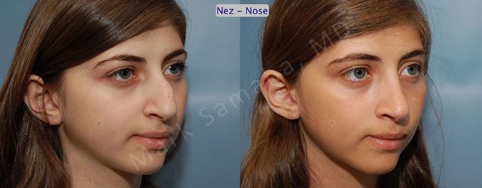 Before & After Rhinoplastie / Rhinoplasty Case 55 View #3 View in Montreal, QC