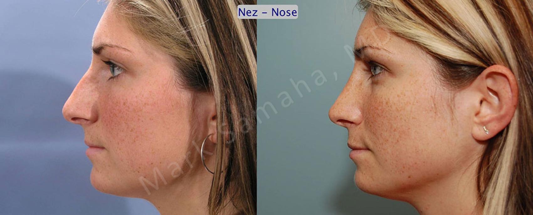 Before & After Rhinoplastie / Rhinoplasty Case 56 View #1 View in Montreal, QC
