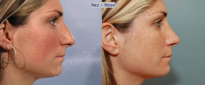 Before & After Rhinoplastie / Rhinoplasty Case 56 View #2 View in Montreal, QC