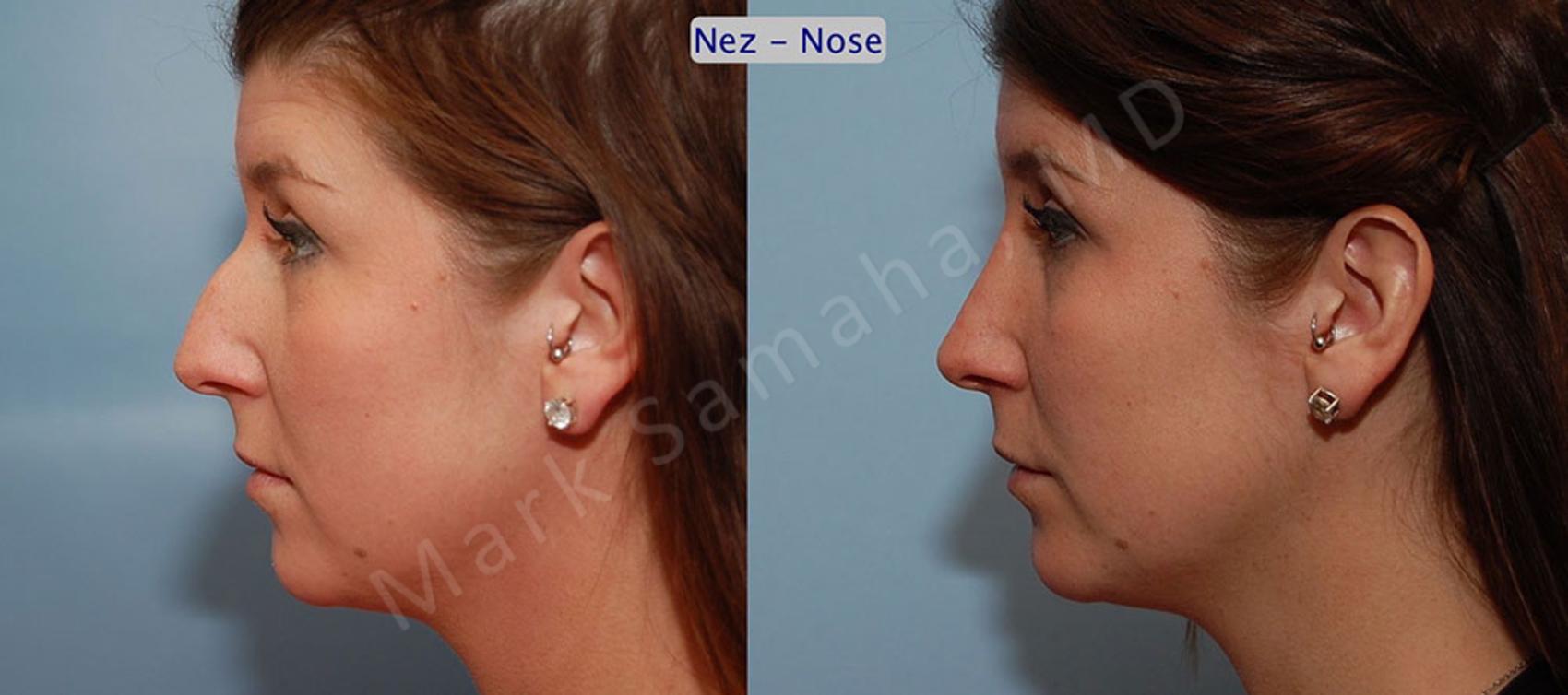 Before & After Rhinoplastie / Rhinoplasty Case 57 View #1 View in Montreal, QC