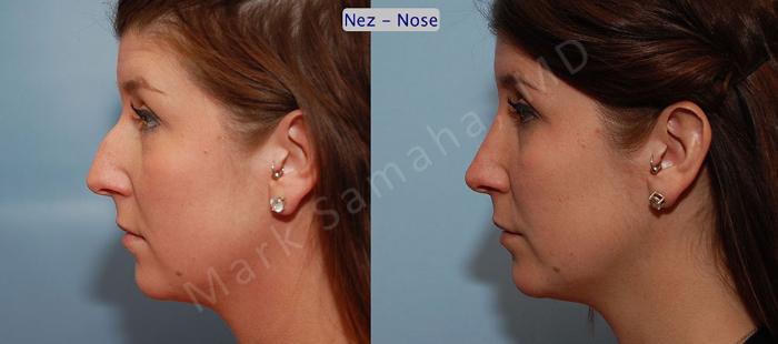 Before & After Rhinoplastie / Rhinoplasty Case 57 View #1 View in Montreal, QC