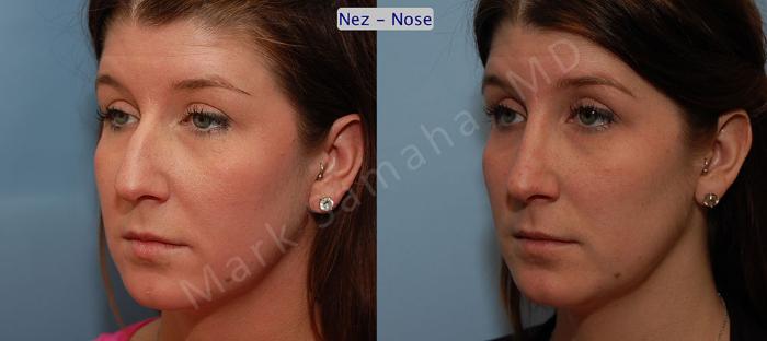Before & After Rhinoplastie / Rhinoplasty Case 57 View #2 View in Montreal, QC