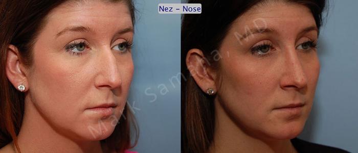 Before & After Rhinoplastie / Rhinoplasty Case 57 View #3 View in Montreal, QC