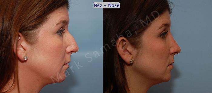 Before & After Rhinoplastie / Rhinoplasty Case 57 View #4 View in Montreal, QC