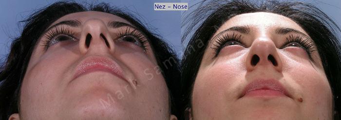 Before & After Rhinoplastie / Rhinoplasty Case 58 View #1 View in Montreal, QC