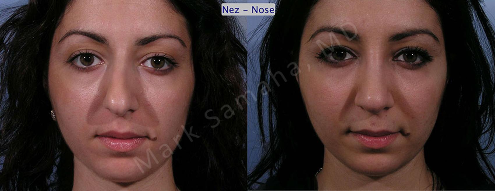 Before & After Rhinoplastie / Rhinoplasty Case 58 View #2 View in Montreal, QC