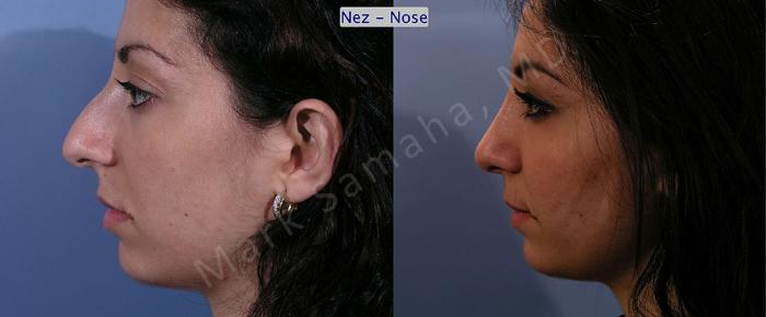 Before & After Rhinoplastie / Rhinoplasty Case 58 View #3 View in Montreal, QC