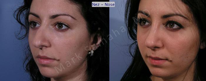 Before & After Rhinoplastie / Rhinoplasty Case 58 View #4 View in Montreal, QC