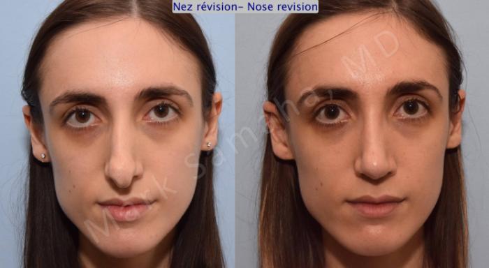 Before & After Rhinoplastie / Rhinoplasty Case 75 View #1 View in Montreal, QC