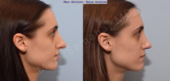 Before & After Rhinoplastie / Rhinoplasty Case 75 View #3 View in Montreal, QC