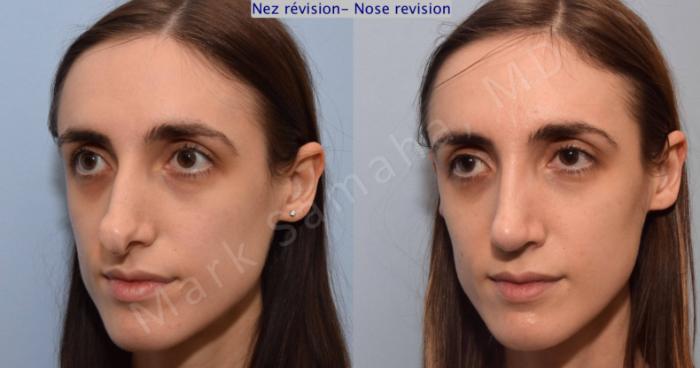 Before & After Rhinoplastie / Rhinoplasty Case 75 View #4 View in Montreal, QC