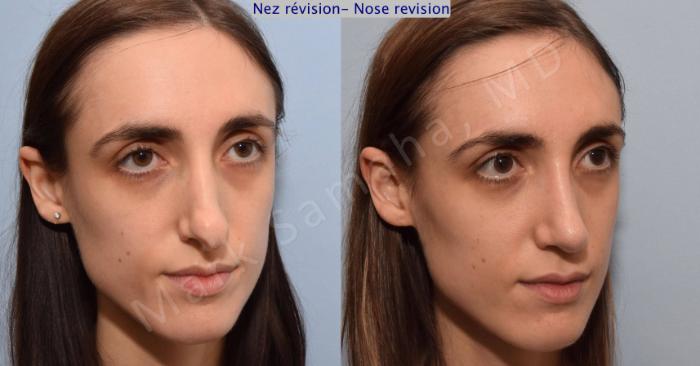 Before & After Rhinoplastie / Rhinoplasty Case 75 View #5 View in Montreal, QC