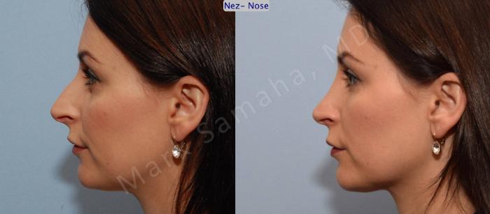 Before & After Rhinoplastie / Rhinoplasty Case 76 View #1 View in Montreal, QC