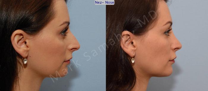 Before & After Rhinoplastie / Rhinoplasty Case 76 View #2 View in Mount Royal, QC