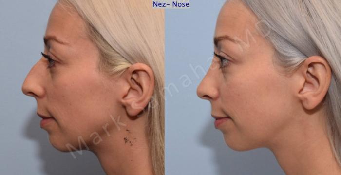 Before & After Rhinoplastie / Rhinoplasty Case 77 View #1 View in Mount Royal, QC