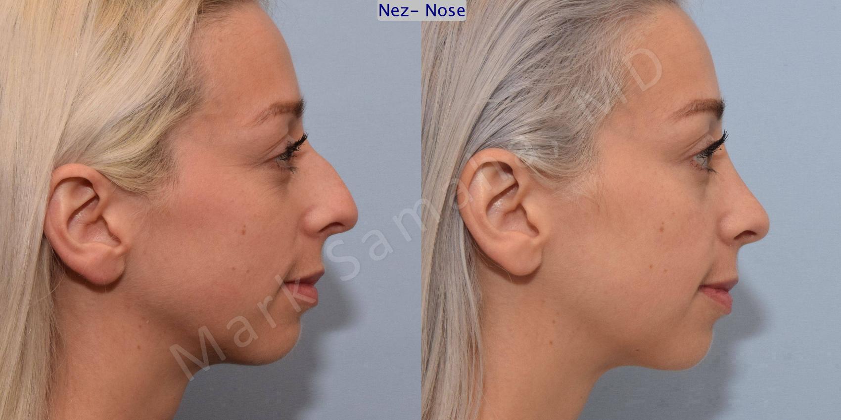 Before & After Rhinoplastie / Rhinoplasty Case 77 View #2 View in Mount Royal, QC