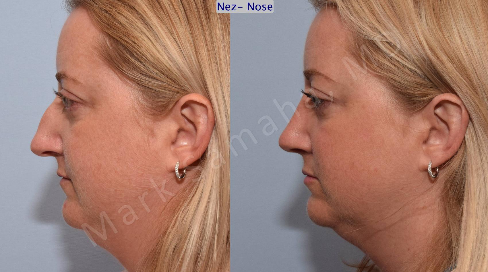 Before & After Rhinoplastie / Rhinoplasty Case 78 View #1 View in Montreal, QC