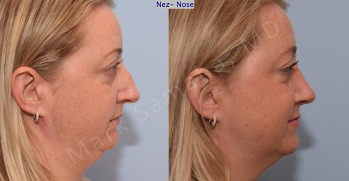 Before & After Rhinoplastie / Rhinoplasty Case 78 View #2 View in Montreal, QC