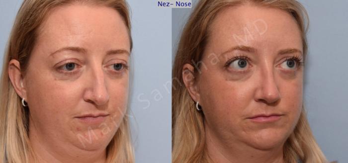 Before & After Rhinoplastie / Rhinoplasty Case 78 View #3 View in Montreal, QC