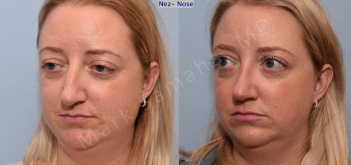 Before & After Rhinoplastie / Rhinoplasty Case 78 View #4 View in Montreal, QC
