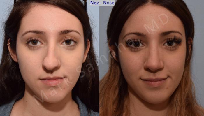 Before & After Rhinoplastie / Rhinoplasty Case 79 View #1 View in Montreal, QC