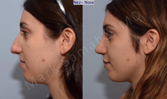 Before & After Rhinoplastie / Rhinoplasty Case 79 View #2 View in Montreal, QC