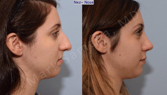 Before & After Rhinoplastie / Rhinoplasty Case 79 View #3 View in Montreal, QC