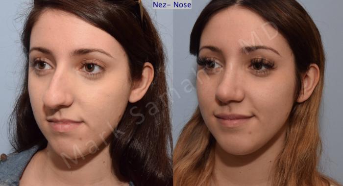 Before & After Rhinoplastie / Rhinoplasty Case 79 View #4 View in Montreal, QC