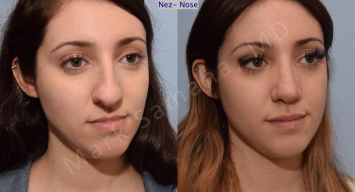 Before & After Rhinoplastie / Rhinoplasty Case 79 View #5 View in Montreal, QC