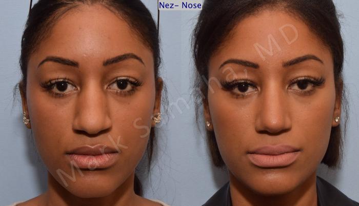 Before & After Rhinoplastie / Rhinoplasty Case 81 View #1 View in Montreal, QC