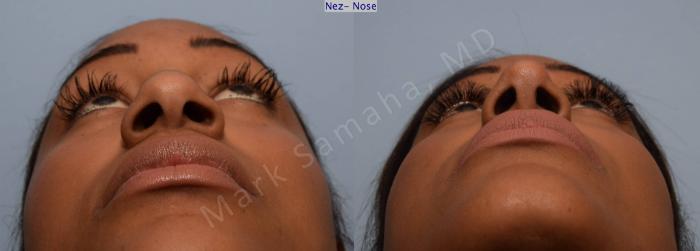 Before & After Rhinoplastie / Rhinoplasty Case 81 View #2 View in Montreal, QC
