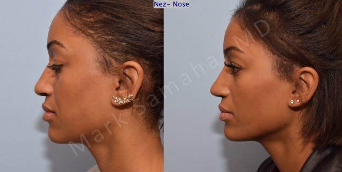 Before & After Rhinoplastie / Rhinoplasty Case 81 View #3 View in Montreal, QC