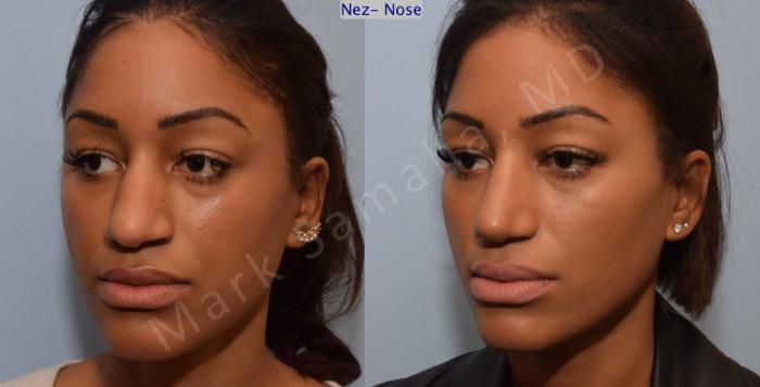 Before & After Rhinoplastie / Rhinoplasty Case 81 View #4 View in Montreal, QC