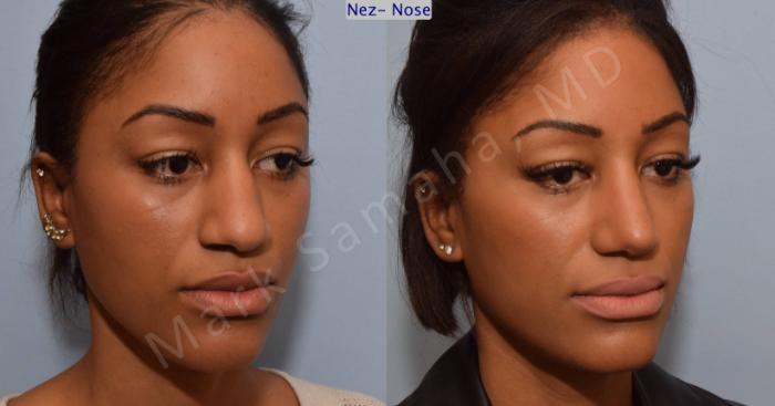 Before & After Rhinoplastie / Rhinoplasty Case 81 View #5 View in Montreal, QC