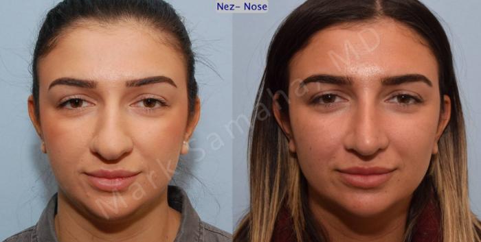 Before & After Rhinoplastie / Rhinoplasty Case 82 View #1 View in Montreal, QC