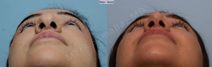 Before & After Rhinoplastie / Rhinoplasty Case 82 View #2 View in Montreal, QC