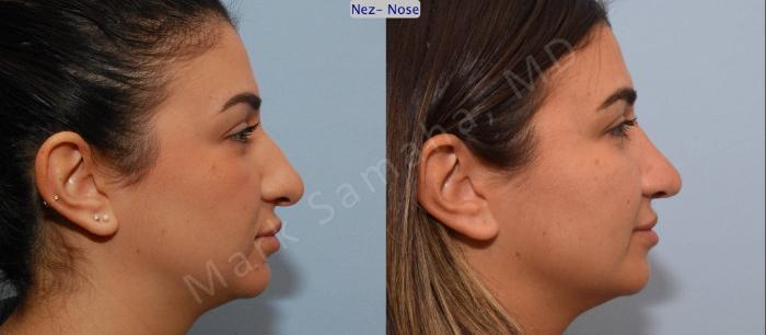 Before & After Rhinoplastie / Rhinoplasty Case 82 View #3 View in Montreal, QC